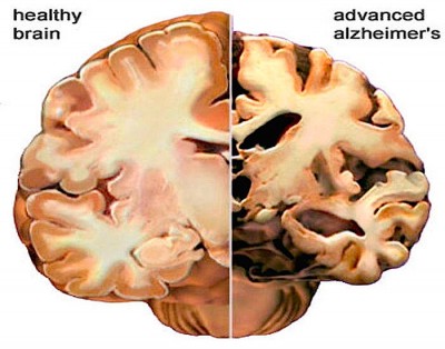 alzheimer-brain.jpg